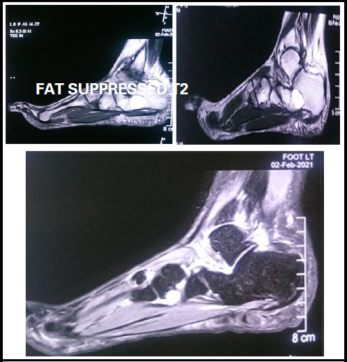 Intraosseous Lipoma of Calcaneus An Uncommon Cause of Heel Pain: A Case Report.