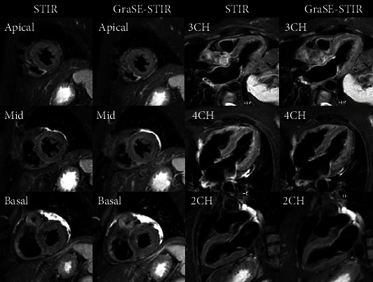 Enhanced Myocardial Tissue Visualization: A Comparative Cardiovascular Magnetic Resonance Study of Gradient-Spin Echo-STIR and Conventional STIR Imaging.