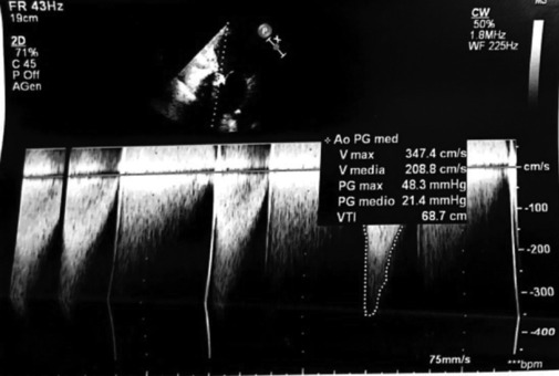 The Heart Team during the Pandemic: A Case Report of Bio-Prosthesis Degeneration Treated with Valve in Valve Implantation.