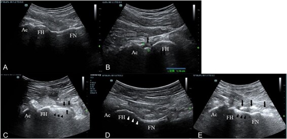 Feasibility and potential of intraoperative ultrasound in arthroscopy of femoroacetabular impingement.