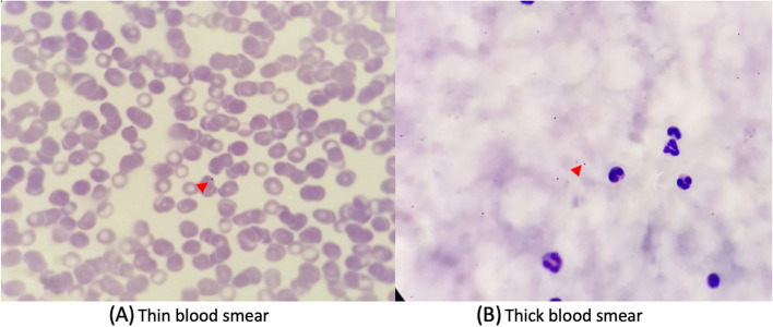 Challenges of diagnosing severe malaria with complications in adult patients: a case report.