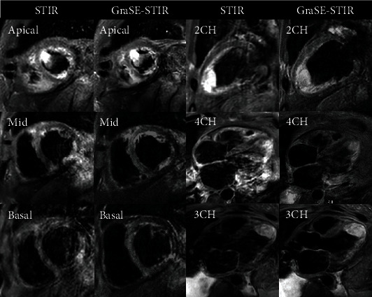 Enhanced Myocardial Tissue Visualization: A Comparative Cardiovascular Magnetic Resonance Study of Gradient-Spin Echo-STIR and Conventional STIR Imaging.