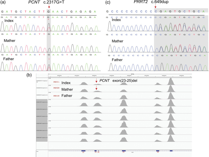 Dual diagnosis of microcephalic osteosplastic primary dwarfism type II and benign familial infantile seizure type 2: a case report.