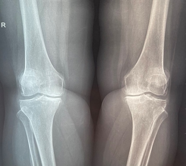 Knee Osteoarthritis-Current Diagnosis and Treatment Options-A Narrative Review.
