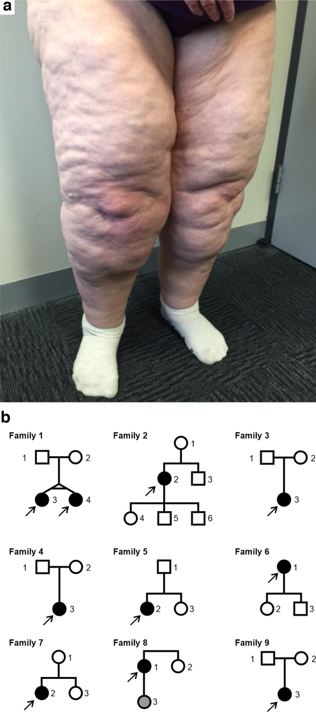 A Family-Based Study of Inherited Genetic Risk in Lipedema.