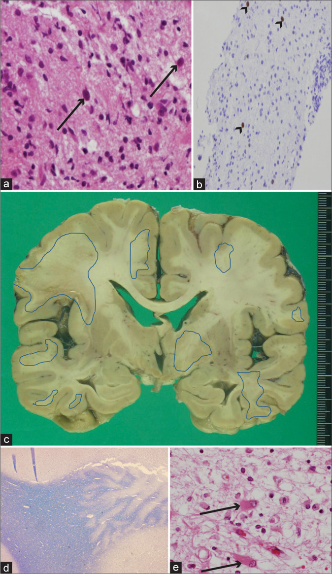 Progressive multifocal leukoencephalopathy associated with rituximab treatment.