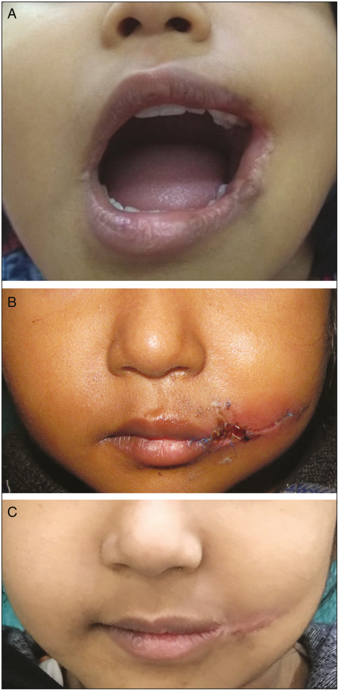 Successful management of an unusual hypopigmented scar after surgical repair of a unilateral Tessier 7 cleft.