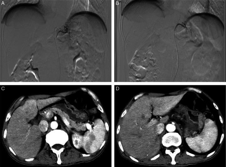Pathologic Complete Response After Gastric Artery Chemoembolization Combined With Tislelizumab for Neoadjuvant Therapy of Locally Advanced Gastric Cancer: A Case Report.