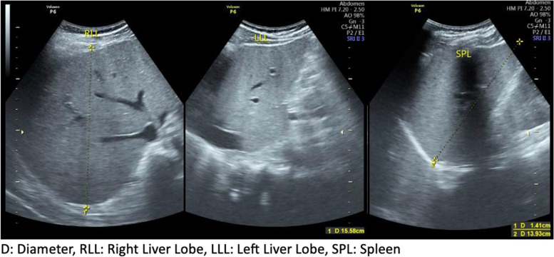 Challenges of diagnosing severe malaria with complications in adult patients: a case report.