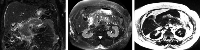 Impact of Imaging Techniques in the Assessment of Gallstone Pancreatitis.