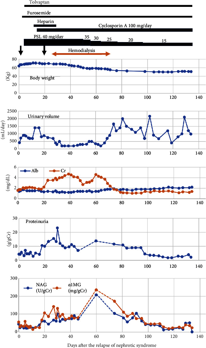An Elderly Case of Minimal Change Nephrotic Syndrome: Correlation between Renal Tubular Dysfunction and the Onset of Oliguric Acute Kidney Injury Requiring Hemodialysis.