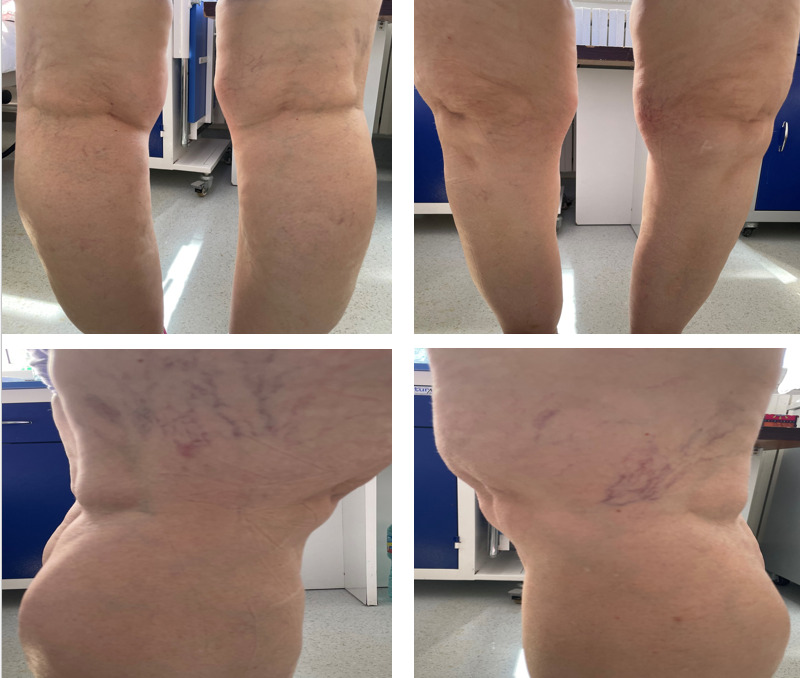 Knee Osteoarthritis-Current Diagnosis and Treatment Options-A Narrative Review.