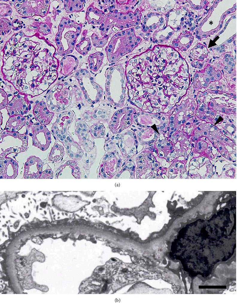 An Elderly Case of Minimal Change Nephrotic Syndrome: Correlation between Renal Tubular Dysfunction and the Onset of Oliguric Acute Kidney Injury Requiring Hemodialysis.