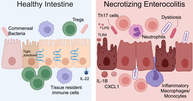 DNA methylation in necrotizing enterocolitis.