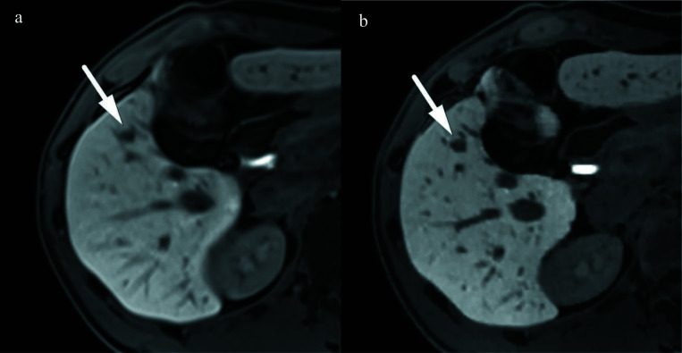 Breath-hold High-resolution T1-weighted Gradient Echo Liver MR Imaging with Compressed Sensing Obtained during the Gadoxetic Acid-enhanced Hepatobiliary Phase: Image Quality and Lesion Visibility Compared with a Standard T1-weighted Sequence.
