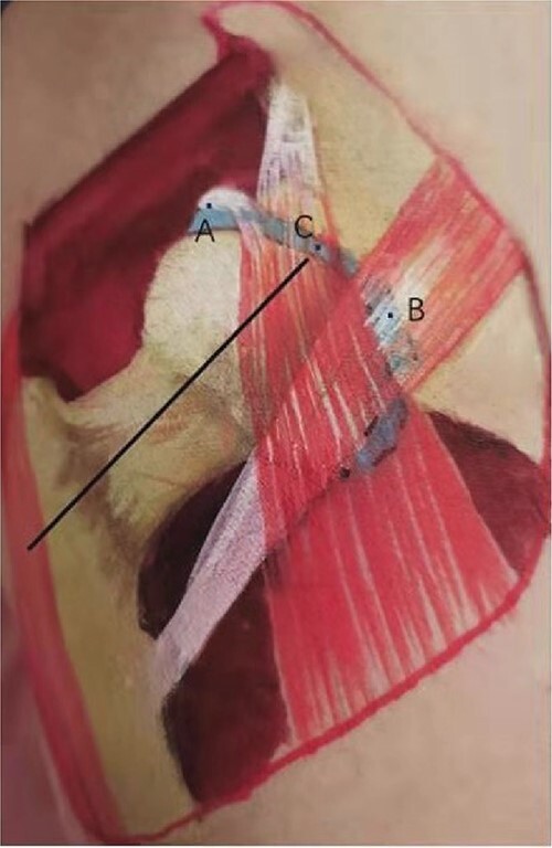 Feasibility and potential of intraoperative ultrasound in arthroscopy of femoroacetabular impingement.