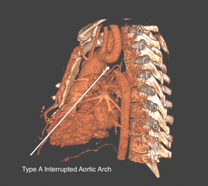 Dieulafoy's Lesion: A Rare Cause of Gastrointestinal Bleeding after Interrupted Aortic Arch Repair in an Adult.