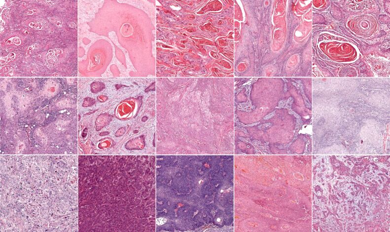 Automated cutaneous squamous cell carcinoma grading using deep learning with transfer learning.