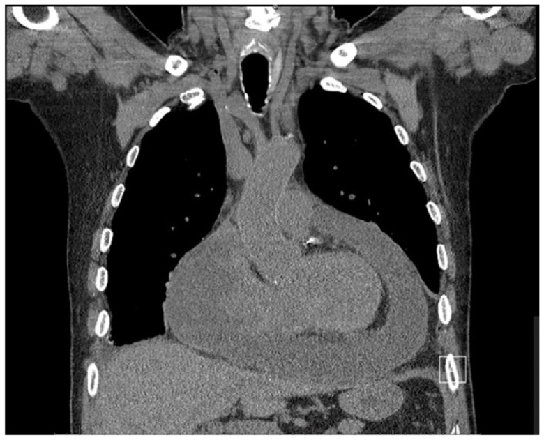 Drug-Induced Lupus Following mRNA COVID-19 Vaccination and Monoclonal Antibody Infusion for Treatment of COVID-19 Infection.