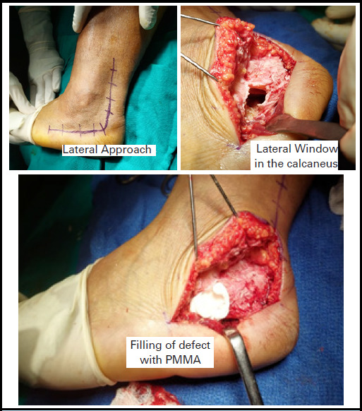 Intraosseous Lipoma of Calcaneus An Uncommon Cause of Heel Pain: A Case Report.
