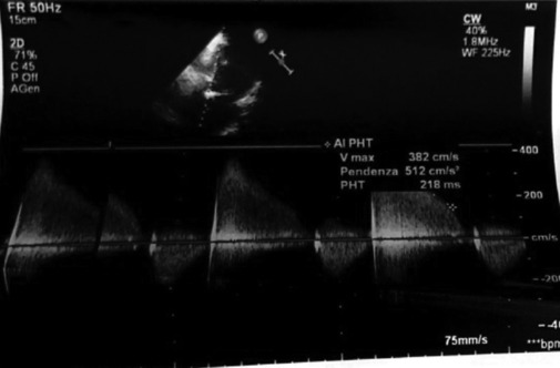 The Heart Team during the Pandemic: A Case Report of Bio-Prosthesis Degeneration Treated with Valve in Valve Implantation.