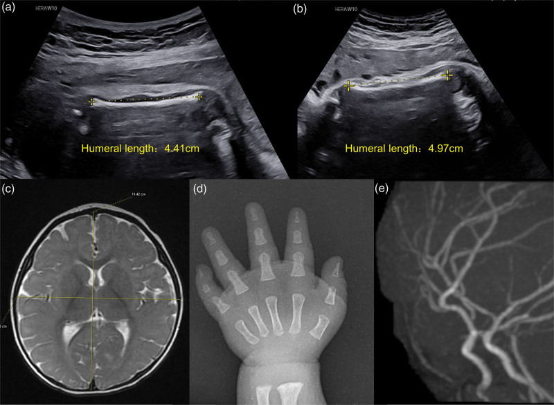 Dual diagnosis of microcephalic osteosplastic primary dwarfism type II and benign familial infantile seizure type 2: a case report.