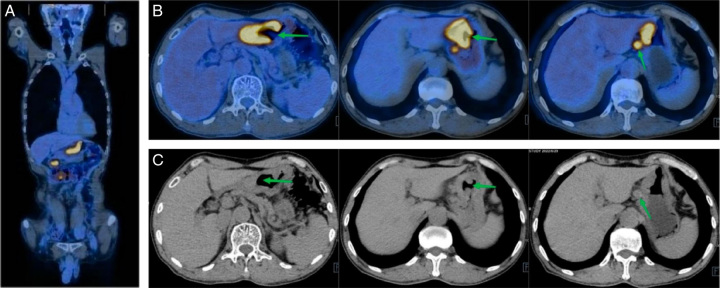 Pathologic Complete Response After Gastric Artery Chemoembolization Combined With Tislelizumab for Neoadjuvant Therapy of Locally Advanced Gastric Cancer: A Case Report.