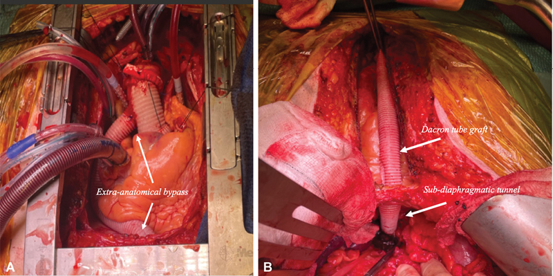 Dieulafoy's Lesion: A Rare Cause of Gastrointestinal Bleeding after Interrupted Aortic Arch Repair in an Adult.