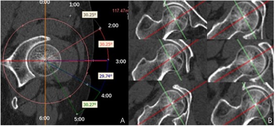Feasibility and potential of intraoperative ultrasound in arthroscopy of femoroacetabular impingement.