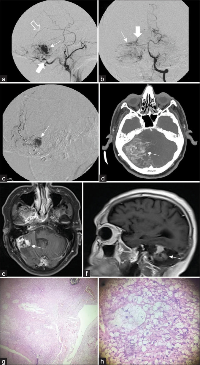 Multimodal management of giant solid hemangioblastomas in two patients with preoperative embolization.