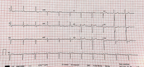 The Heart Team during the Pandemic: A Case Report of Bio-Prosthesis Degeneration Treated with Valve in Valve Implantation.