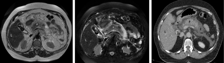 Impact of Imaging Techniques in the Assessment of Gallstone Pancreatitis.