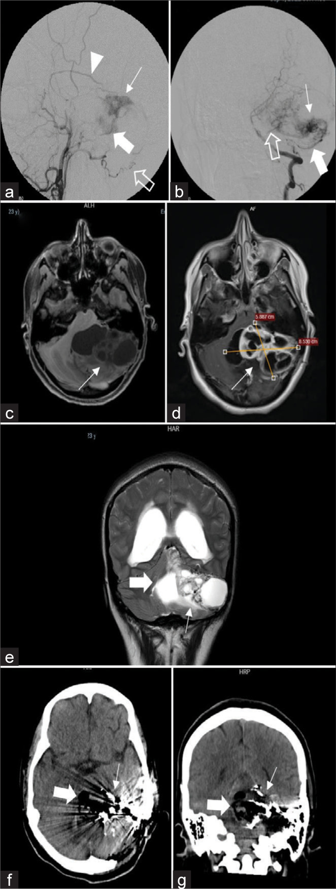 Multimodal management of giant solid hemangioblastomas in two patients with preoperative embolization.