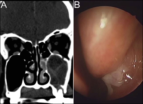 Retrospective comparison of first-line treatments for odontogenic sinusitis based on duration of symptoms.