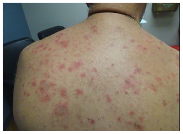 Drug-Induced Lupus Following mRNA COVID-19 Vaccination and Monoclonal Antibody Infusion for Treatment of COVID-19 Infection.