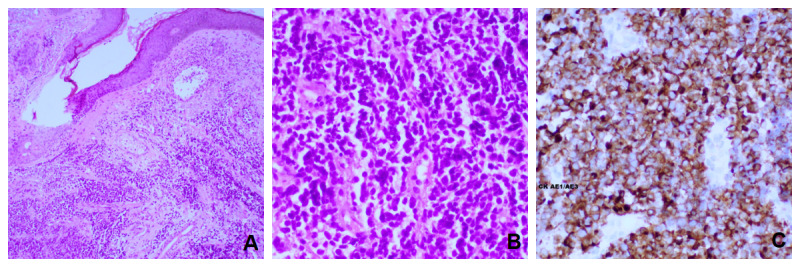 Merkel Cell Carcinoma on the Face: Case Report.