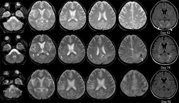 A Case of Spastic Quadriplegia Remaining after Multiple Traumatic Injuries Complicated by Sepsis and Reversible Posterior Leukoencephalopathy Syndrome, as well as Delayed Multifocal Microbleeds.