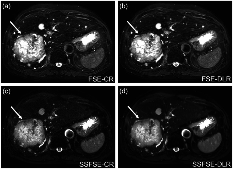 Effect of Deep Learning Reconstruction on Respiratory-triggered T2-weighted MR Imaging of the Liver: A Comparison between the Single-shot Fast Spin-echo and Fast Spin-echo Sequences.