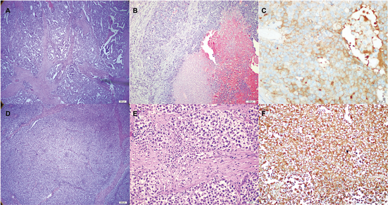 Bilateral Synchronous Testicular Cancer with Discordant Histopathology: A Case Report.