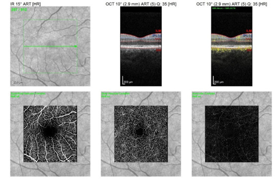 Comparative Analysis of Retinal Structural and Angiographic Parameters in Diabetic Patients, Alzheimer's Disease Patients, and Healthy Controls: An OCT-Based Study.