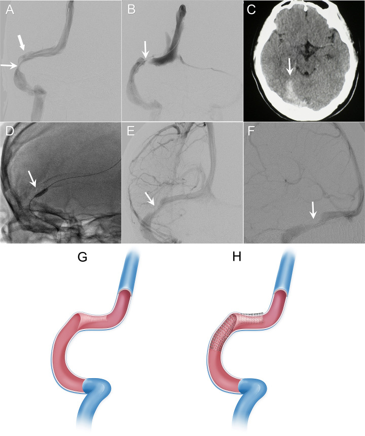 Dural sinus septum: an underlying cause of cerebral venous sinus stenting failure and complications.