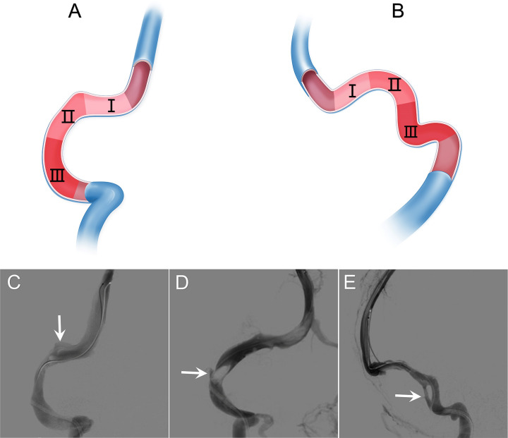 Dural sinus septum: an underlying cause of cerebral venous sinus stenting failure and complications.