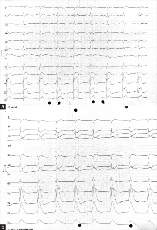 Acute Myocardial Infarction with Refractory Cardiogenic Shock after High-Voltage Electrocution: An Intriguing Case.