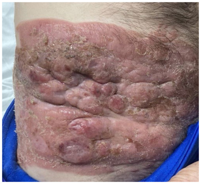 Tumor Stage Mycosis Fungoides with Lymph Node Involvement.