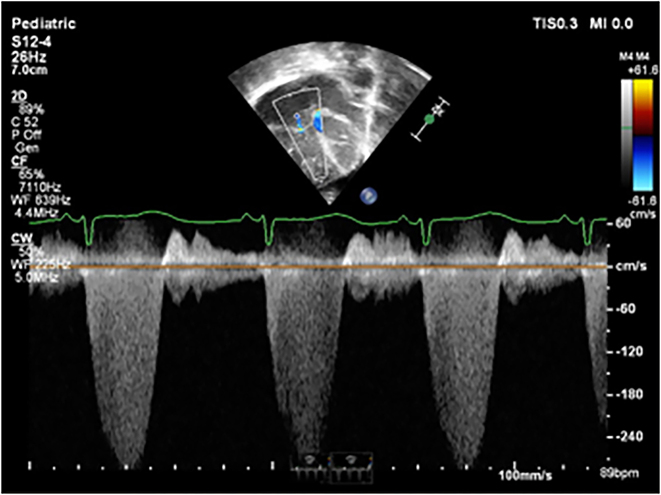 Persistent pulmonary hypertension of the newborn infant (PPHN) due to premature closure of the ductus arteriosus (DA).