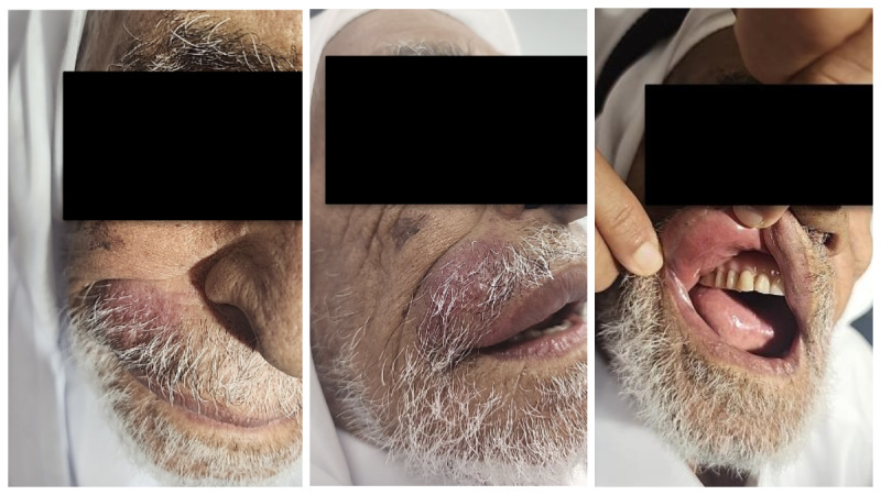 Merkel Cell Carcinoma on the Face: Case Report.