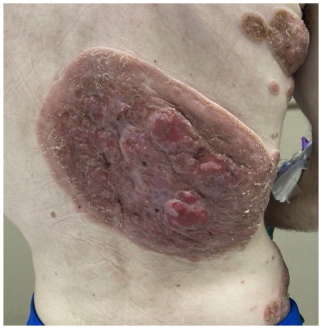 Tumor Stage Mycosis Fungoides with Lymph Node Involvement.