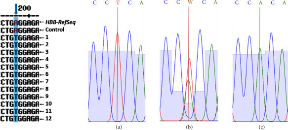 Detection of Asymptomatic Sickle Cell Hemoglobin Carriers and Fetal Hemoglobin Regulating Genetic Variants in African Descendants from Oaxaca, Mexico.