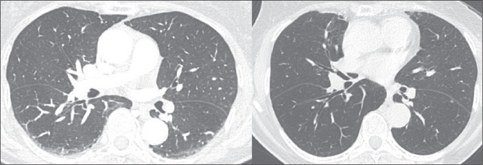 "Interstitial lung abnormalities": translation to and use in Portuguese.