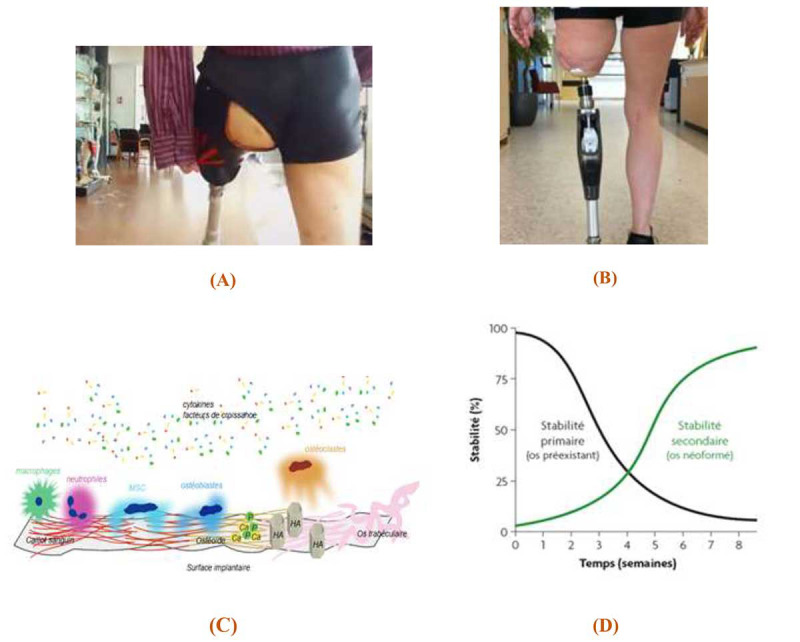 Modeling of a New Percutaneous Orthopedic Implant System to Control the Post-surgery Osseointegration Process.